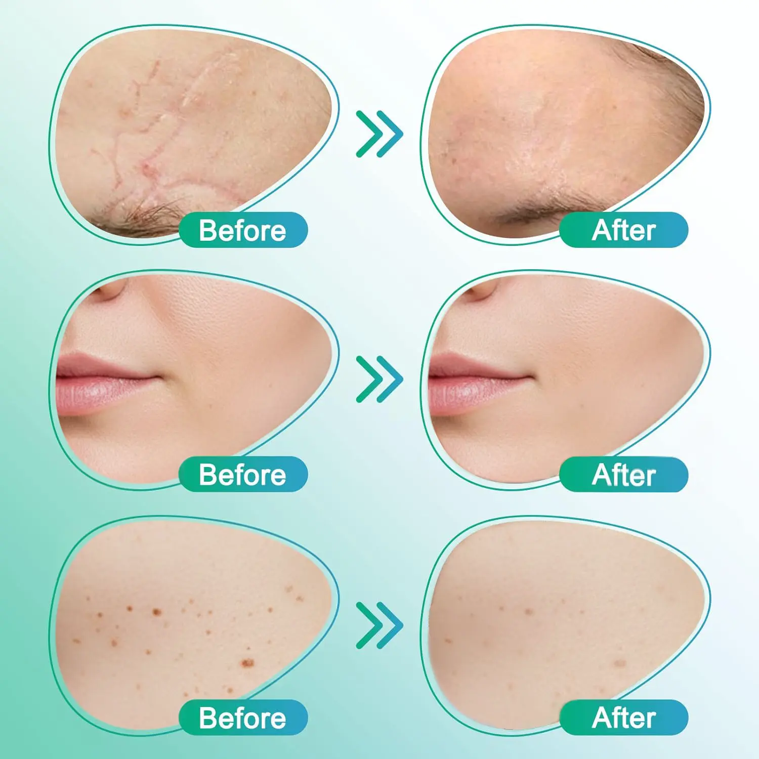 𝗖𝗮𝗿𝗲𝗕𝗿𝗲𝗲𝘇𝗲® 3 viename mikroadatos priežiūros pleistras - Image 5