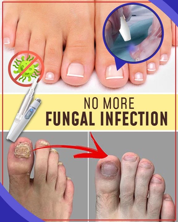 Priešgrybeliniai mėlynos šviesos gydymo rinkiniai - Image 3