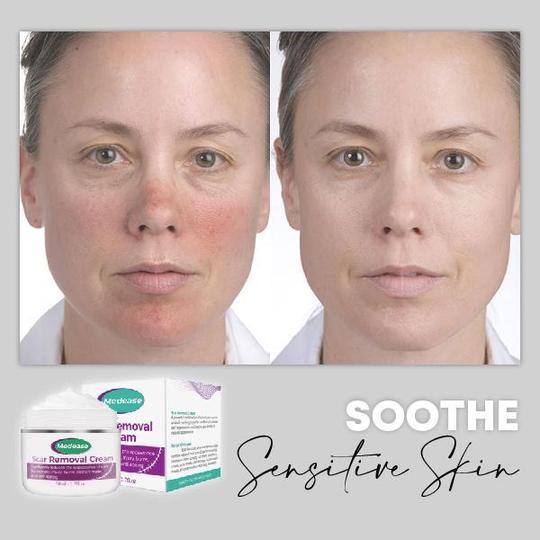 Medease Skin Rebound kremas - Image 6