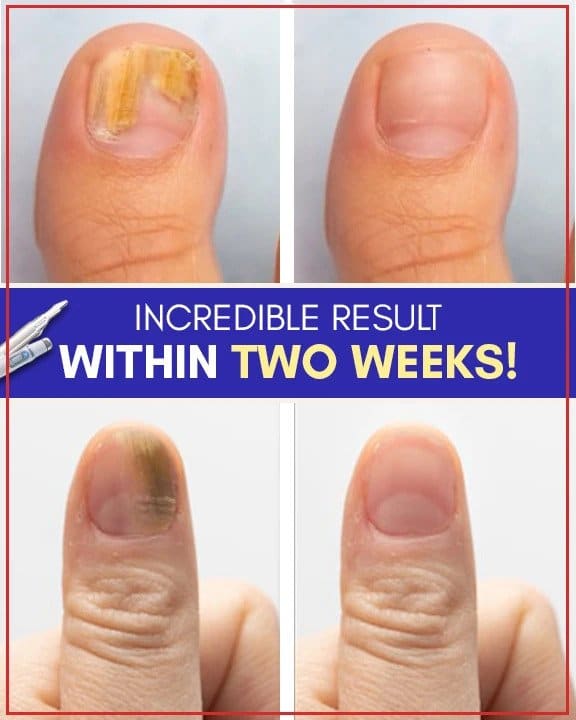 Priešgrybeliniai mėlynos šviesos gydymo rinkiniai - Image 5