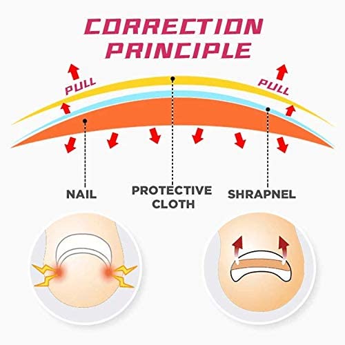 Įaugusio nago koregavimo pleistras - Image 5
