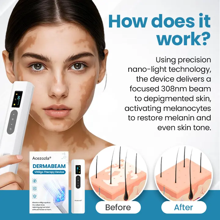 Acezozla® DermaBeam vitiligo terapijos prietaisas - Image 3