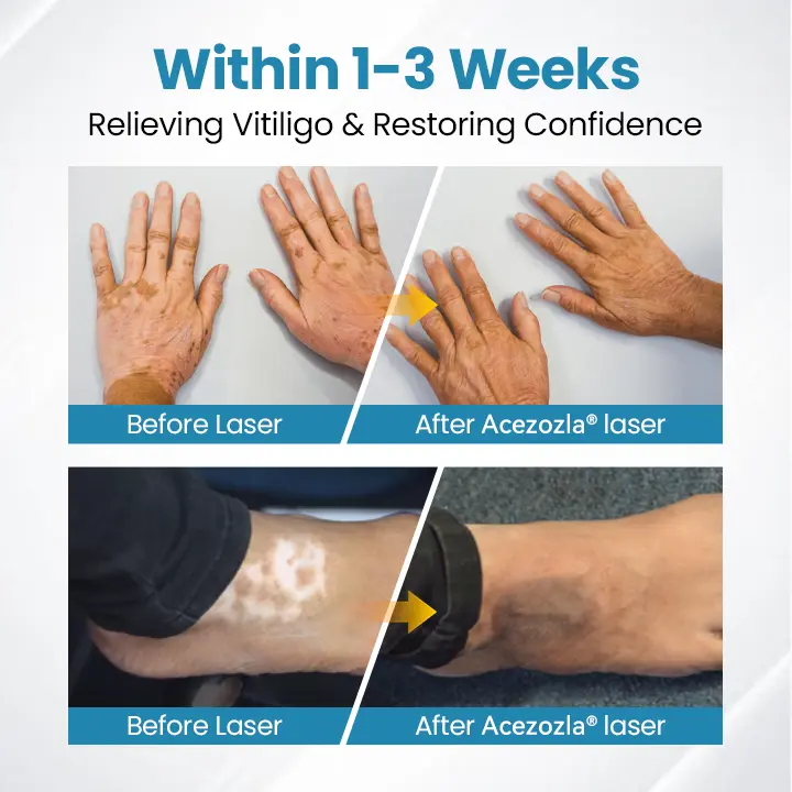 Acezozla® DermaBeam vitiligo terapijos prietaisas - Image 4