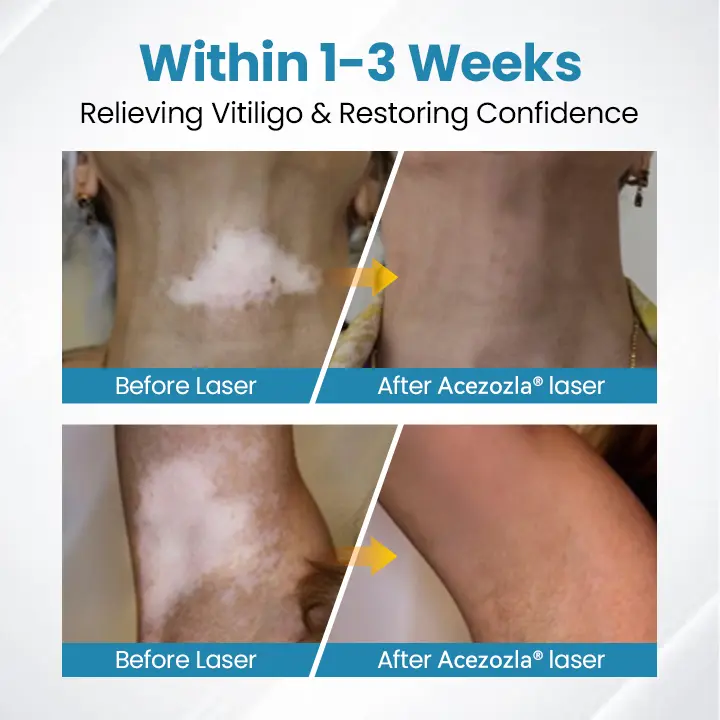 Acezozla® DermaBeam vitiligo terapijos prietaisas - Image 5
