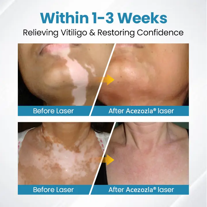 Acezozla® DermaBeam vitiligo terapijos prietaisas - Image 7