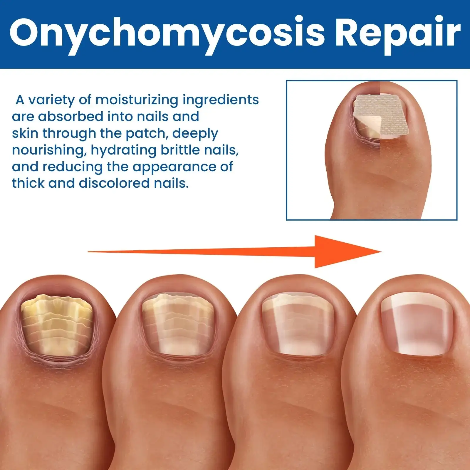 Acezozla® grybelio nagų taisymo pleistrai - Image 4